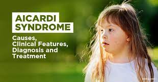 A Quiz On The Aicardi Syndrome thumbnail